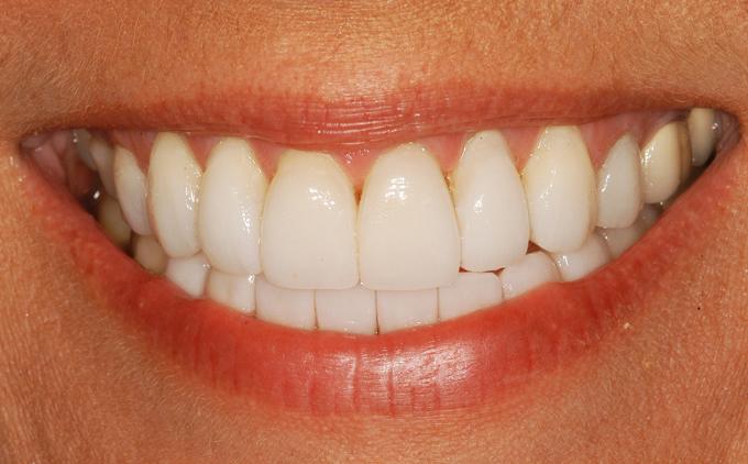 Veneers Dentures Sedation Dentist