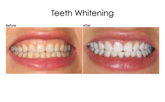 Teeth Whitening Service