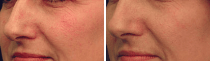 V-Beam Laser Vein Removal Before & After