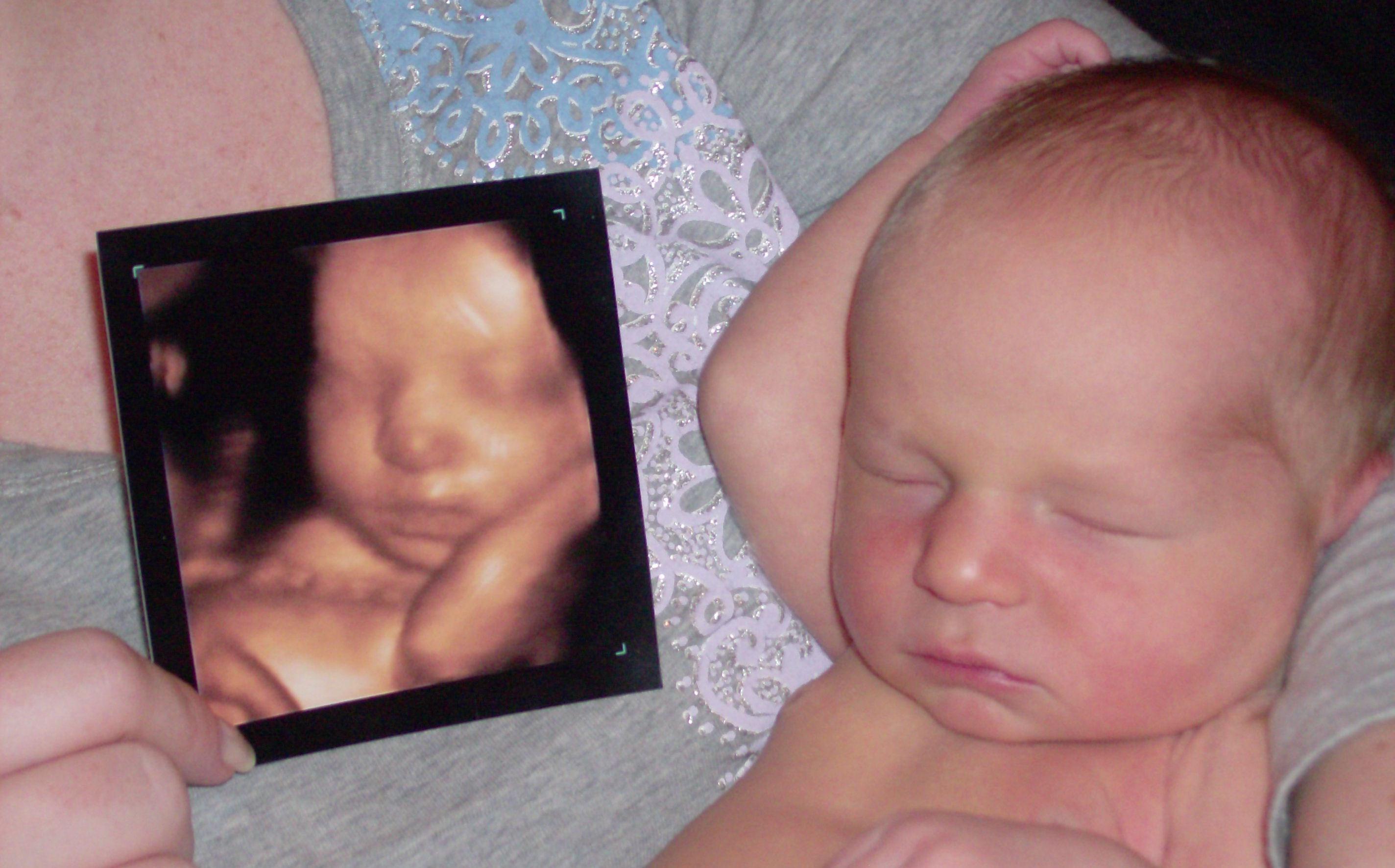 3d ultrasound before and after photo