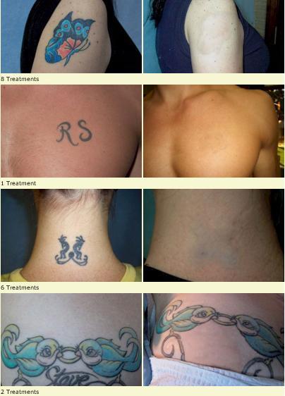 Tattoo Removal Photos (courtesy of Tattoo Vanish)