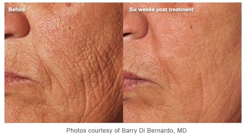 Cutera Laser Skin Tightening & Collagen Remodeling