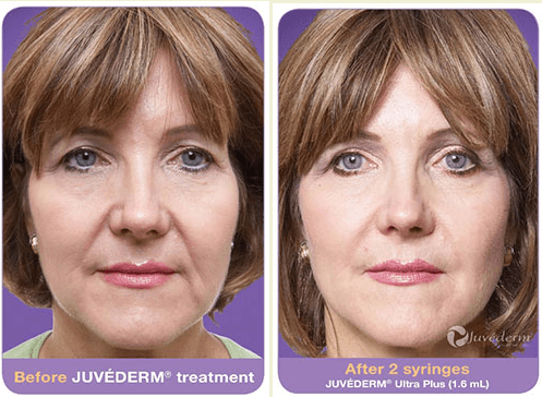 Erase years with Juvederm!