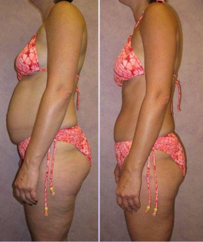 Lose 20 Pounds in 21 Days with the hCG Diet!