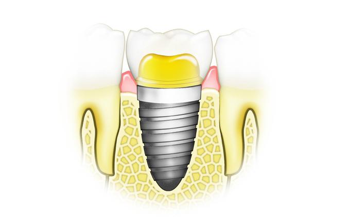 Implants Cosmetic Dentist