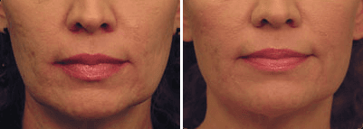 Laser Skin Tightening Before & After at Blue Water Spa