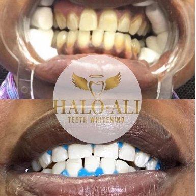 Halo Ali Teeth Whitening