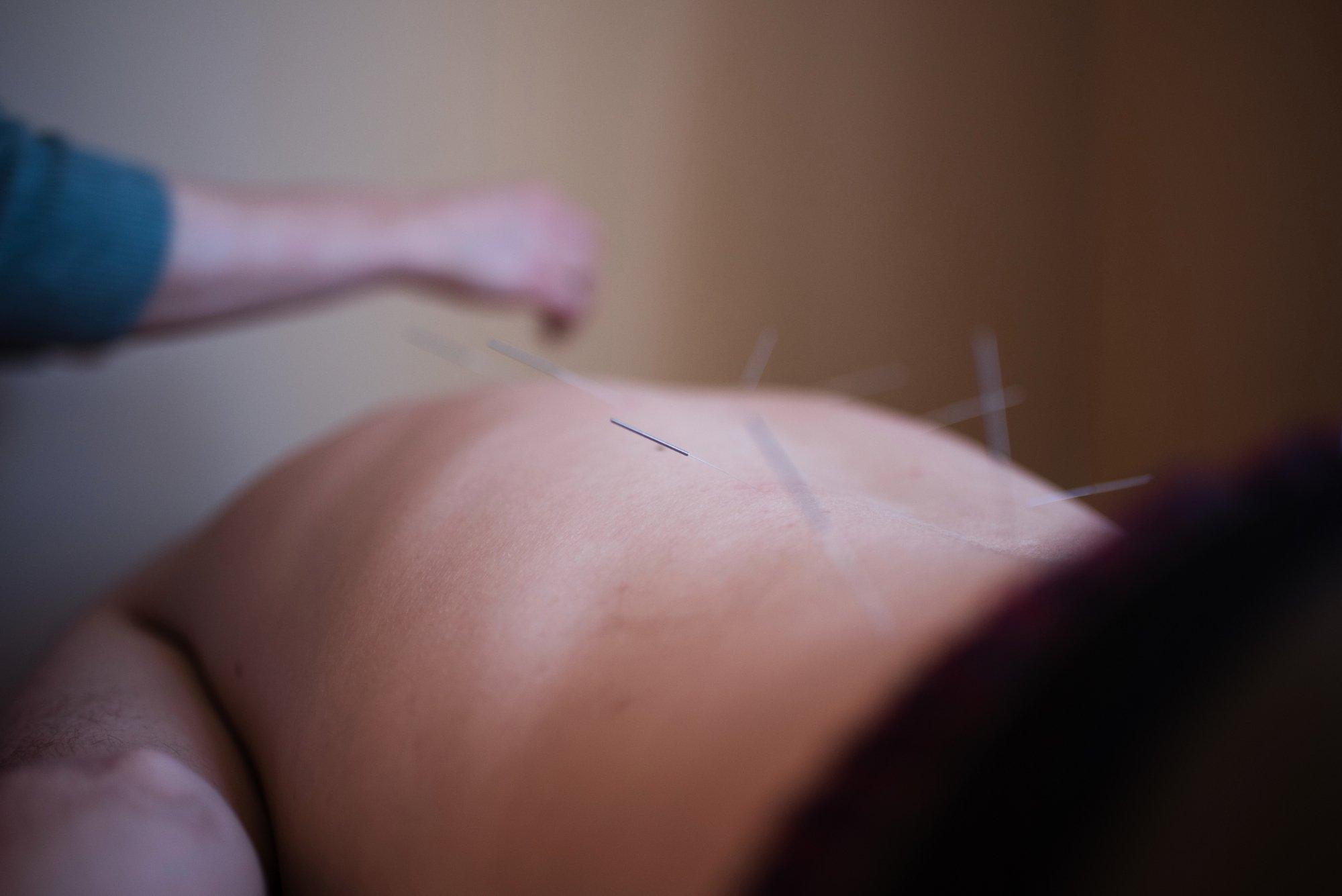 Infinite Wellness Acupuncture