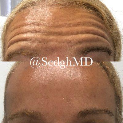 Amazing results with Botox treatment. Dr. Ray Sedgh, MD