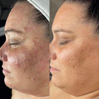 2 months of DMK Enzyme treatments and customized skin care at home