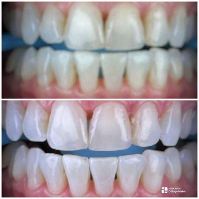 No EDITS! We deliver results and education at First Glance Teeth Whitening. NO PAIN