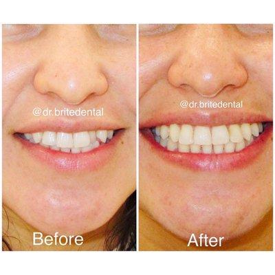 One tooth can completely change your smile using braces!!