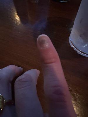 My finger immediately after and you can see my ice  water cup I was using to ice it in the background on the right.