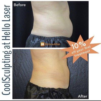 CoolSculpting fat reduction, CoolSculpting, CoolSculpting results, tummy fat, body sculpting, before and after,