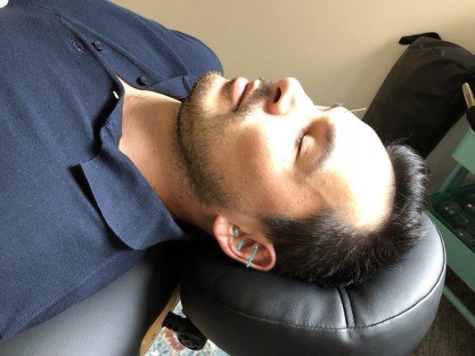 Ear Acupuncture