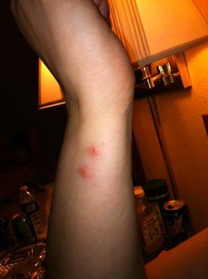 More bites I got while staying there