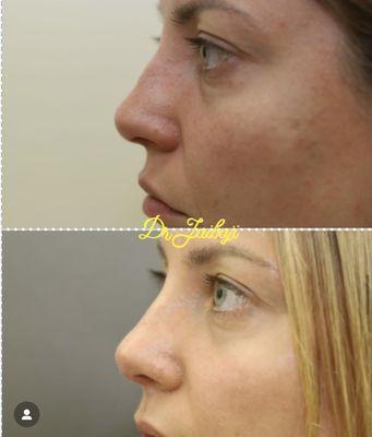 Rhinoplasty