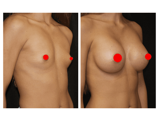 Procedure:Breast Augmentation Benefits: Improve breast appearance Anesthesia : General Complimentary consultation