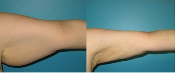 Arm Liposuction done by Dr Atluri