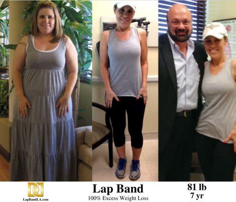 Lap Band Los Angeles Before and After by bariatric surgeon Dr. Davtyan