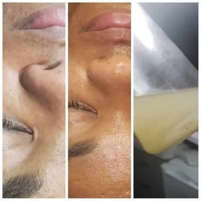 Diamond  HydraFacial, Before, and After