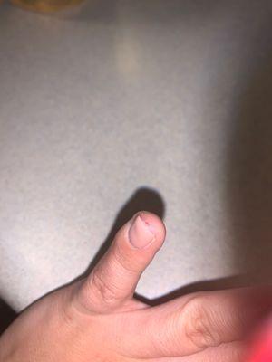 Skin was ripped off from under my nail