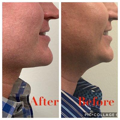 Fractora tightens loose skin for a flawless jawline