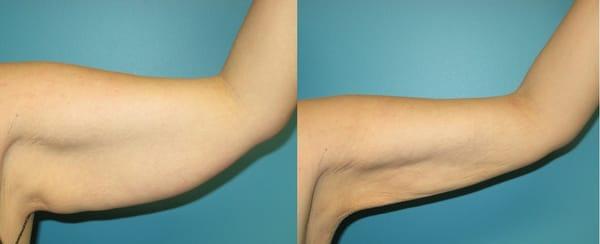 Arm Liposuction done by Dr Atluri