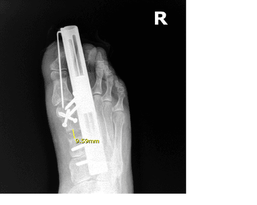 Osteogenesis of 1st metatarsal