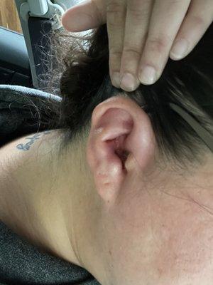 Right Ear Right after Removal