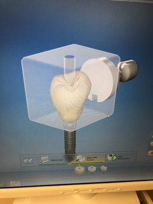 Cad Cam implant crown