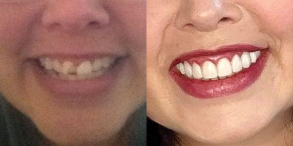 A whole new smile thanks to Dr. Chen!