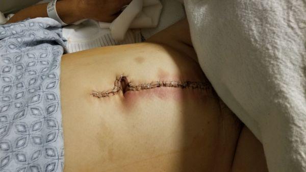 Hysterectomy incision - one day after