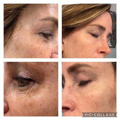 Before and after 2 treatments of Microneedling 
spaced 1 month apart. She still has more Microneedling scheduled.