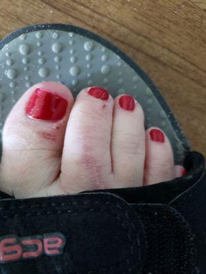 The scar is mine but the scabs around my cuticles are from the pedi.