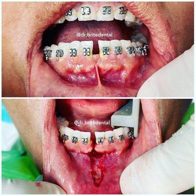 Frenectomy: the frenulum must be completely removed in order for the space to be able to close with braces.