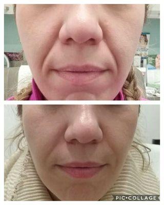 Before and After Nasolabial Filler