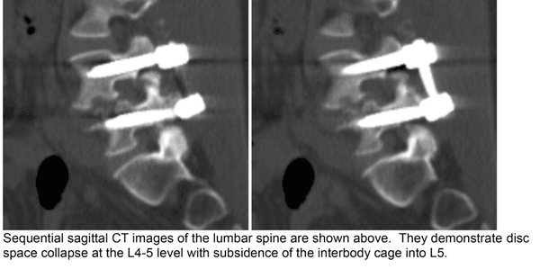 Vertebrae smashed together after Dr. Hott's surgery.