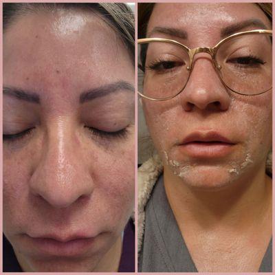 Left is Day 1 post clean skin peel (no peeling yet) 
Right is 2 days after Clean Skin peel (peeling started)