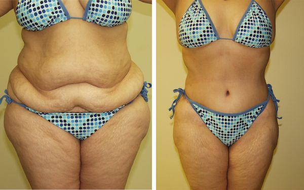 Procedure :Abdominoplasty Benefits: excise excess skin and tighten muscle Anesthesia : General