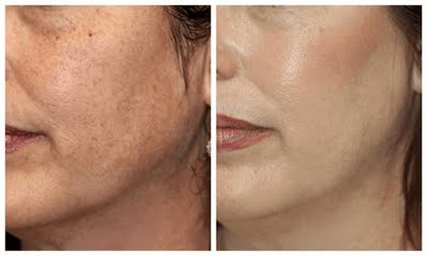 Diamond Tip Microdermabrasion