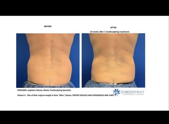 EMBODYMENT's Patient's Before & After Photos