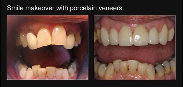 Smile makeover with porcelain veneers.