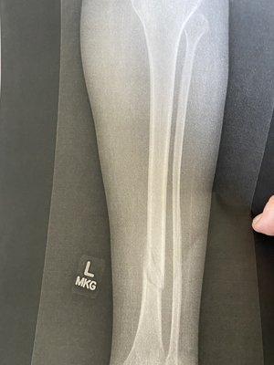 Tibia after two months of bed rest