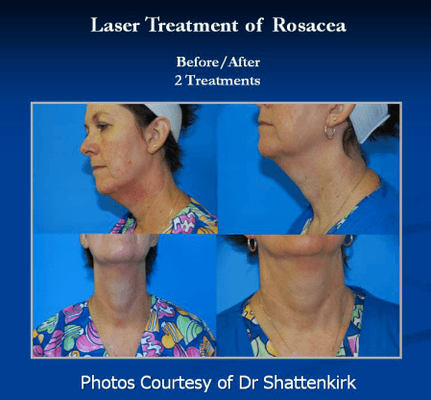 Rosacea Treatment