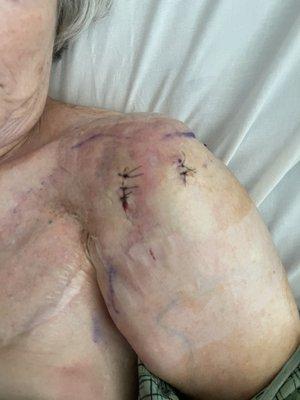 My mother shoulder post surgical.