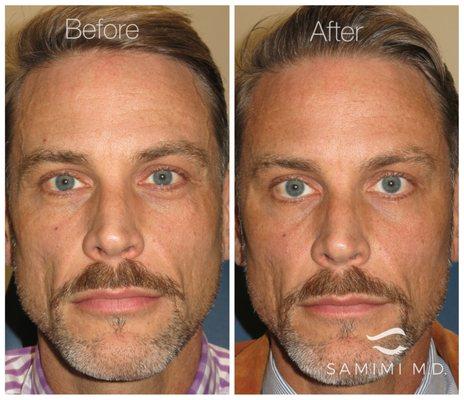 This handsome gentleman had facial rejuvenation with filler and botox with Dr. Samimi. We love his natural and rested looking result!