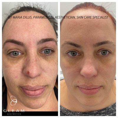 IPL photo facial to brighten skin and reverse sun damage!