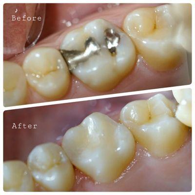 Fixing old and broken filling ontime is a key to preventing tooth loss. We provide tooth colored fillings - composite fillings