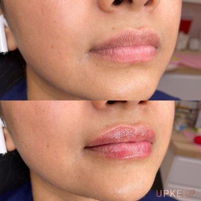 LIP FILLER